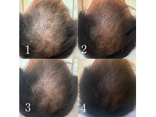 Litの頭皮ケアが大人気！まずはカウンセリングだけでも◎