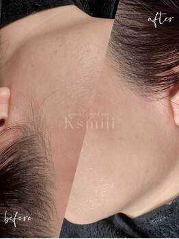 キスミー(Ksmiii)/フェイスワックス　WAX脱毛