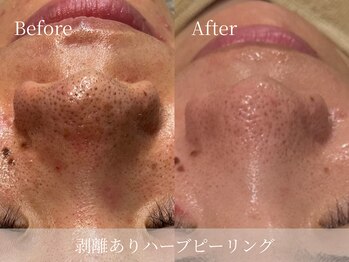 ルミセル(LUMICEL)/毛穴の黒ずみ変化