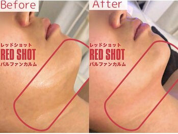 パルファンカルム 駅西本町店/たるみ・二重あごの改善に!