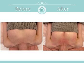 美人バスト 新潟店/ 【バストアップ★育乳】症例