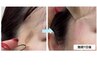 韓国発！はがすシミケア　1箇所　WHITELAB