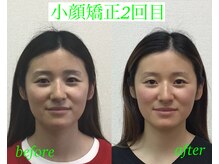 オズ六本木/小顔モニター2回目＠オズ六本木