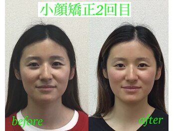 オズ六本木/小顔モニター2回目@オズ六本木