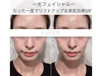 アンジュディ(A'nJUDY)/光フェイシャルビフォーアフター