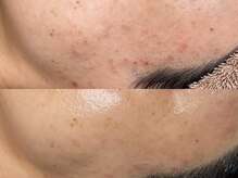 ブラン(BLANC)/ララピール　韓国肌管理