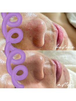 ダオン(Daon)/毛穴改善