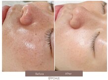 ポアレ 高崎店(POALE)/毛穴ケア症例【群馬/高崎】