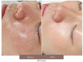 ポアレ 高崎店(POALE)/毛穴ケア症例【群馬/高崎】