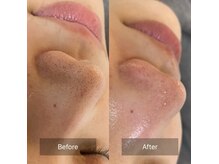 スリーピーオーブ(Sleepy Orb)の雰囲気(毛穴レス肌を目指したい方に。根こそぎ毛穴洗浄は1回でこの変化)