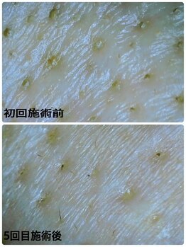 ハーシークレット(Her secret)/ハイドラ毛穴洗浄