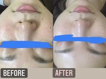 ビアス(Biasu)/小鼻の黒ずみ解消!肌質改善☆