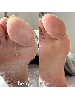 フットミー(foot mii)/