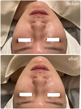 リリィブラン(Lily branc)/毛穴ニキビケア/小顔/美白