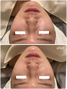 リリィブラン(Lily branc)/毛穴ニキビケア/小顔/美白