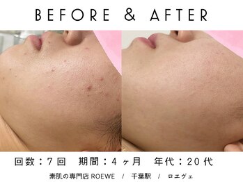 ロエヴェ(ROEWE)/ニキビ改善・毛穴ケア・肌質改善