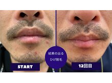 フェイシャル専門サロン サロン ド ウイッシュ/メンズひげ脱毛