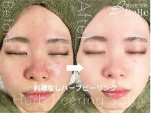 ベル 赤羽(Belle)/ハーブピーリング｜ニキビケア