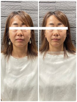 長寿鍼灸院 長寿整骨院/美容鍼50本の効果★ハリ・ツヤ