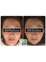 キュープ 小顔美容矯正専門サロン 横浜店(Qpu)/小顔矯正5回の変化