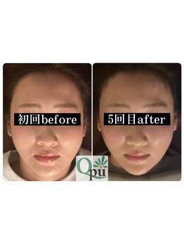 キュープ 小顔美容矯正専門サロン 横浜店(Qpu)/小顔矯正5回の変化