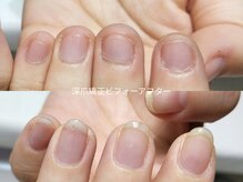 ミンスネイル(Mins Nail)/自爪育成ビフォーアフター