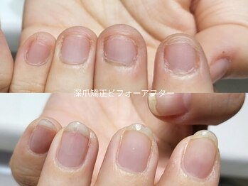 ミンスネイル(Mins Nail)/自爪育成ビフォーアフター