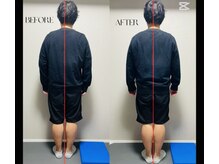 春日整体院ito/【姿勢矯正ビフォーアフター】