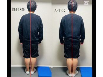 春日整体院ito/【姿勢矯正ビフォーアフター】