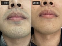 シャイン 防府店(SHINE)の雰囲気（髭脱毛で青髭もなくなり清潔感UP♪）