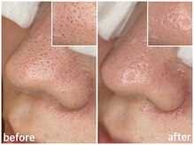 毛穴専科/毛穴洗浄+白玉ワックス メンズ◎