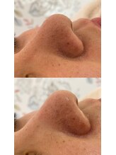 ミント(mint)/#毛穴洗浄#ハーブピーリング