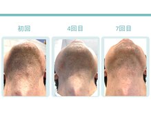 スターポルト(Star-Porte)/ヒゲ脱毛