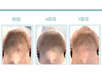 スターポルト(Star-Porte)/ヒゲ脱毛