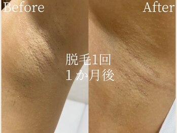 ミスティア(mistia)/脱毛 1回　１か月後