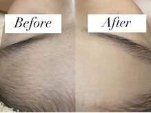 美肌脱毛専門店 パールプラス 大在店/キッズ脱毛