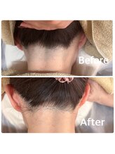 ティアレ 廿日市店(Tiare)/うなじ脱毛