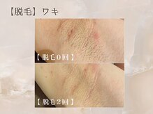 セリーナ 伊賀上野店(CELINA)/【脇】脱毛