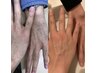 【男の腕まるごと脱毛】10000円★時計やアクセが映える洗練された手元へ