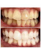 ハク 南船橋店(HAKU)/☆ホワイトニング☆事例写真２