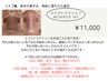 【イチゴ鼻】エクストラクション+光フェイシャル+炭酸ガスパック