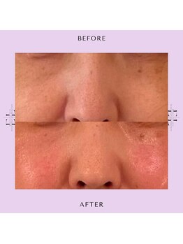 レミュ(Les mieux)/エクソリフト