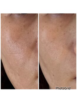 ピュアプラス(Pure Plus)/Before/After