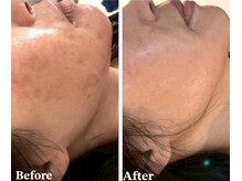 シャイネル(SHYNELL)の雰囲気（ハーブピーリング2回でシミ改善！究極の肌改善9STEP♪）