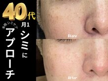テセラ(Tethere)の雰囲気（月1サロンケアでシミ改善）