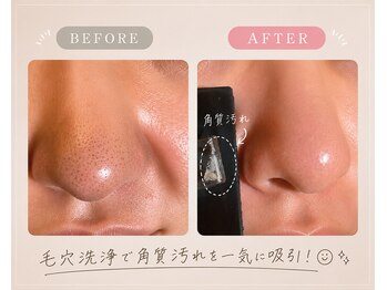 ステラ グランデ 福岡博多/毛穴汚れも毛穴洗浄でスッキリ★