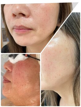 ルアナライフ(Luana Life)/スーパー光改善BBL 50代