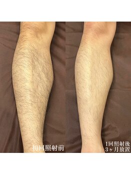 ダリオムズ 西宮北口(DAHLI HOMMES)/☆メンズ脚脱毛☆3ヶ月経過