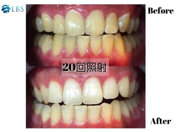 LBSホワイトニング 吉祥寺店/ホワイトニングビフォーアフター