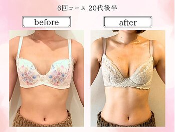 リール 恵比寿店(RIRE)/バストアップ症例【広尾恵比寿】